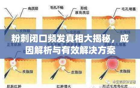 粉刺闭口频发真相大揭秘，成因解析与有效解决方案
