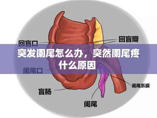 突发阑尾怎么办,突然阑尾疼什么原因